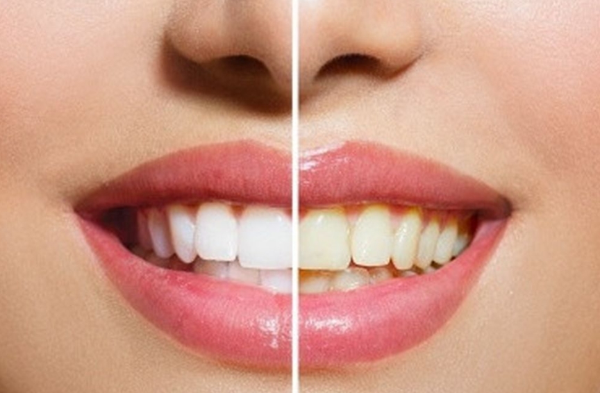 Cara Memtihkan Gigi